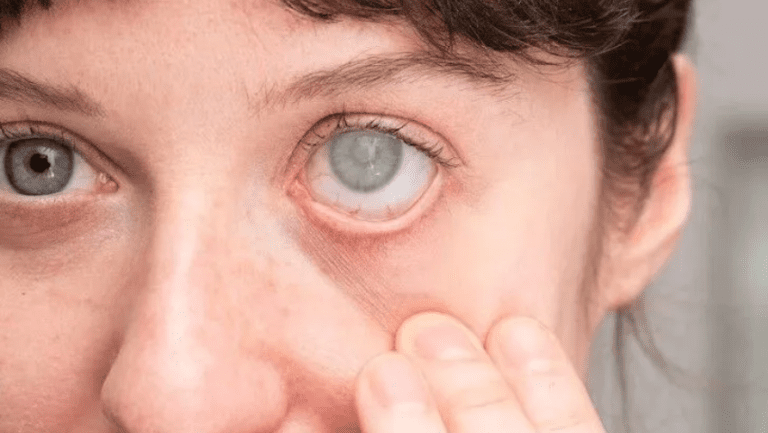 The Complete Guide to Cataract Surgery Recovery Timeline, Tips, and What to Expect
